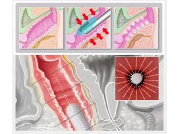 HIFU,  Aparato de HIFU, para Rejuvenecimiento Vaginal