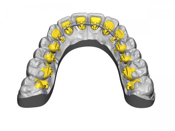 Sistema de brackets linguales personalizados eBrace III