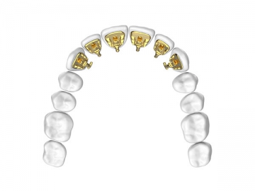 Sistema personalizado de brackets linguales  Visual eBrace