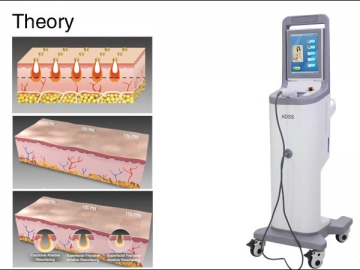 Sistema de radiofrecuencia para estiramiento facial y corporal de 20 Mhz